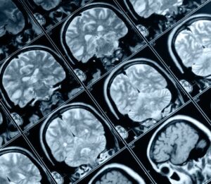 Alzheimer, Parkinson : des ultrasons pour administrer une thérapie génique ?