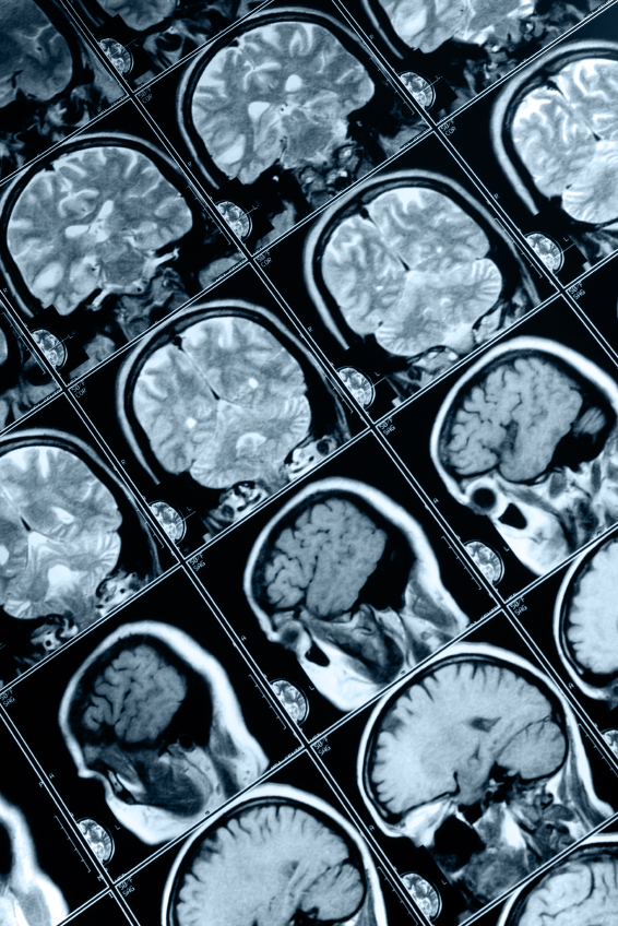 Neurosciences : le livre du Pr Laureys apportera-t-il de nouvelles lumières dans l'affaire Vincent Lambert ?