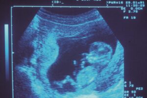 Diagnostic prénatal de trisomie 21 : un gynécologue de Tarbes en procès