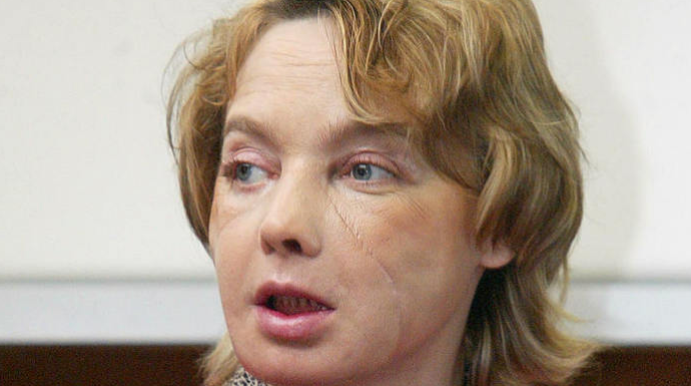 Décès de la première greffée de visage