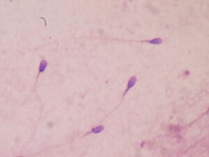 Un test prometteur pour diagnostiquer l’infertilité masculine